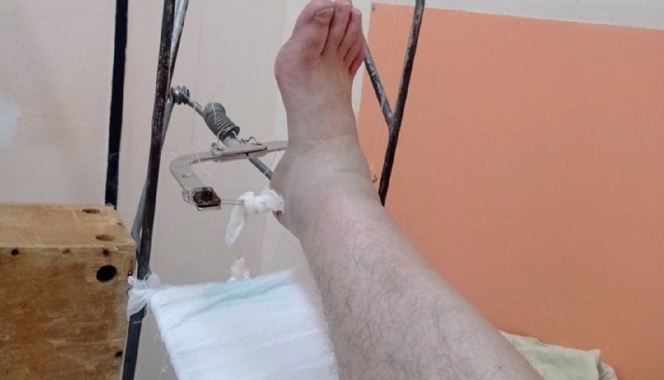 Ярославец сломал ногу в центре города