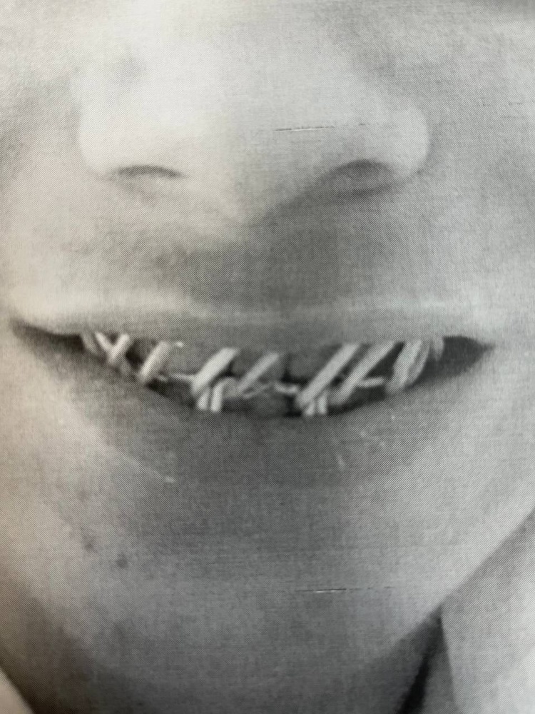 В Ярославской области ученику колледжа в драке сломали челюсть