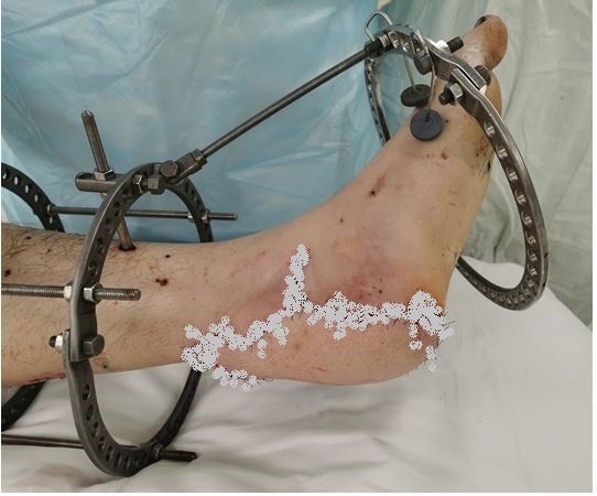 Ярославские хирурги смогли восстановить пациенту оторванную пятку