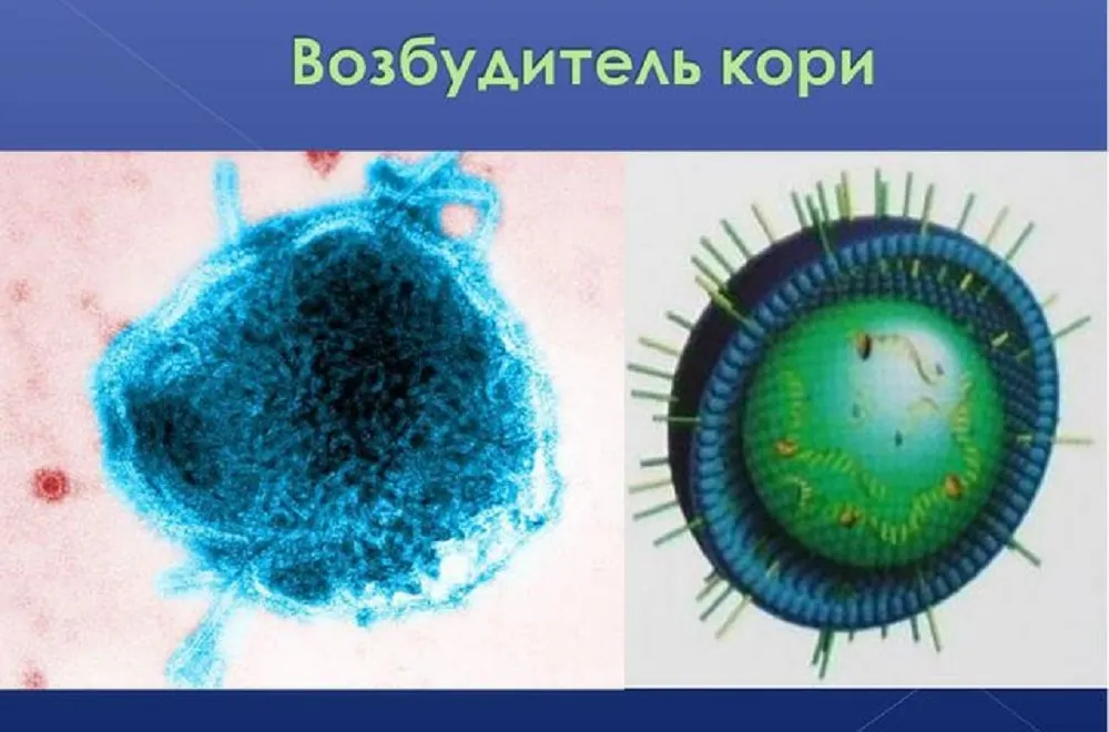 В Ярославской области выявлены 32 случая кори