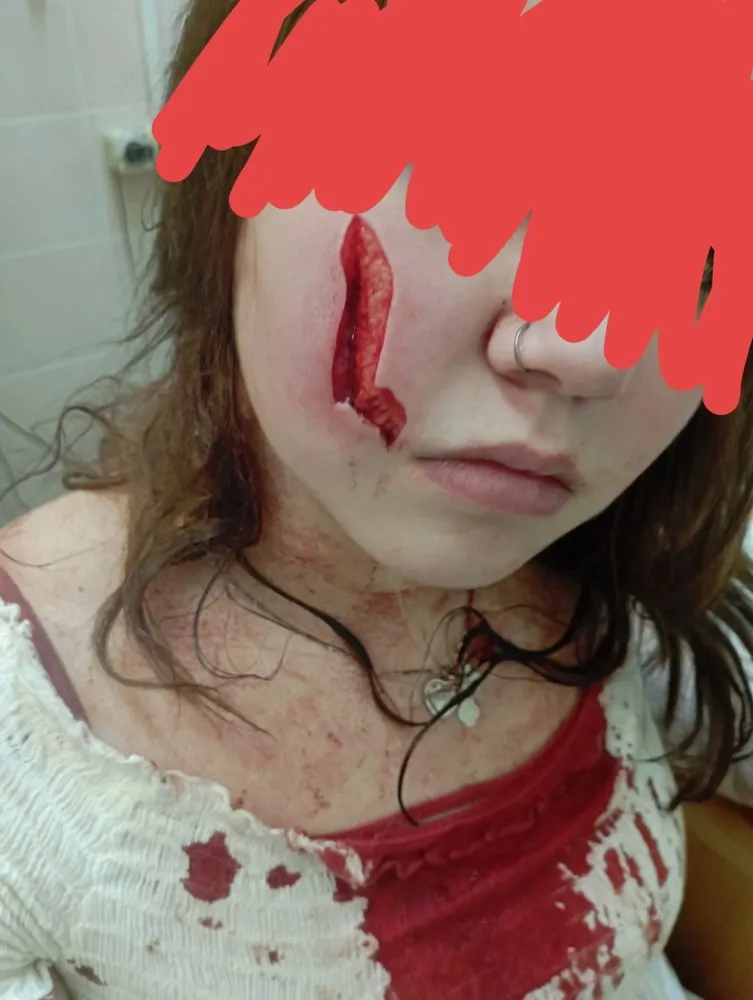 В Ярославской области девушке-подростку изуродовали лицо